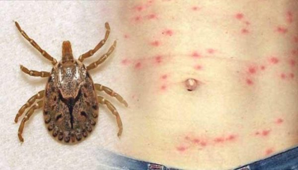 Scrub typhus and dengue patients on the rise