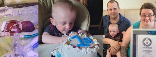 World’s most premature baby who had “zero” chance for survival,  celebrates first birthday