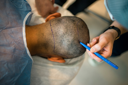 Chitwan CMC announces Interest-free loans for “Hair Transplant” patients